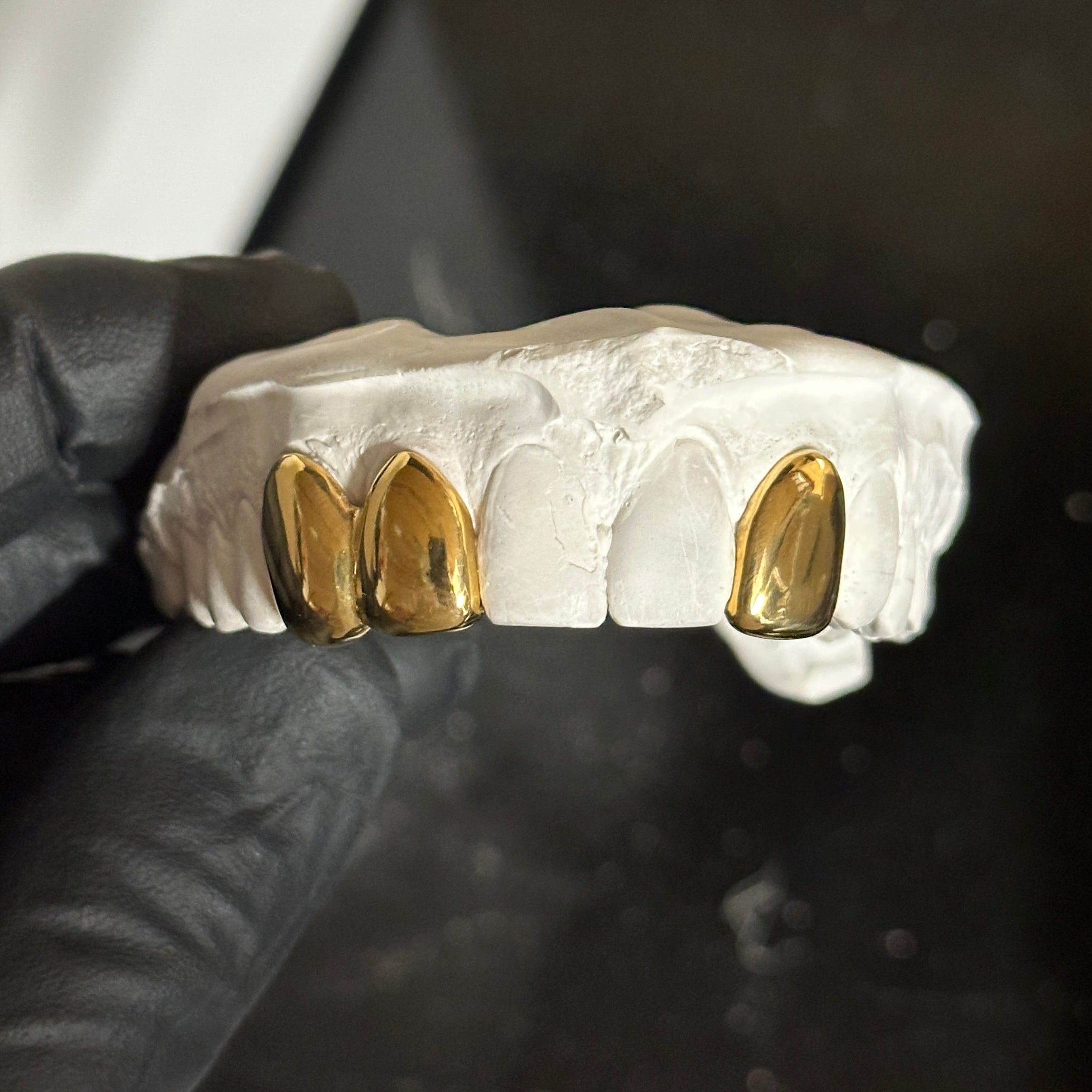 3 dental gold caps on a white stone model held by black gloves